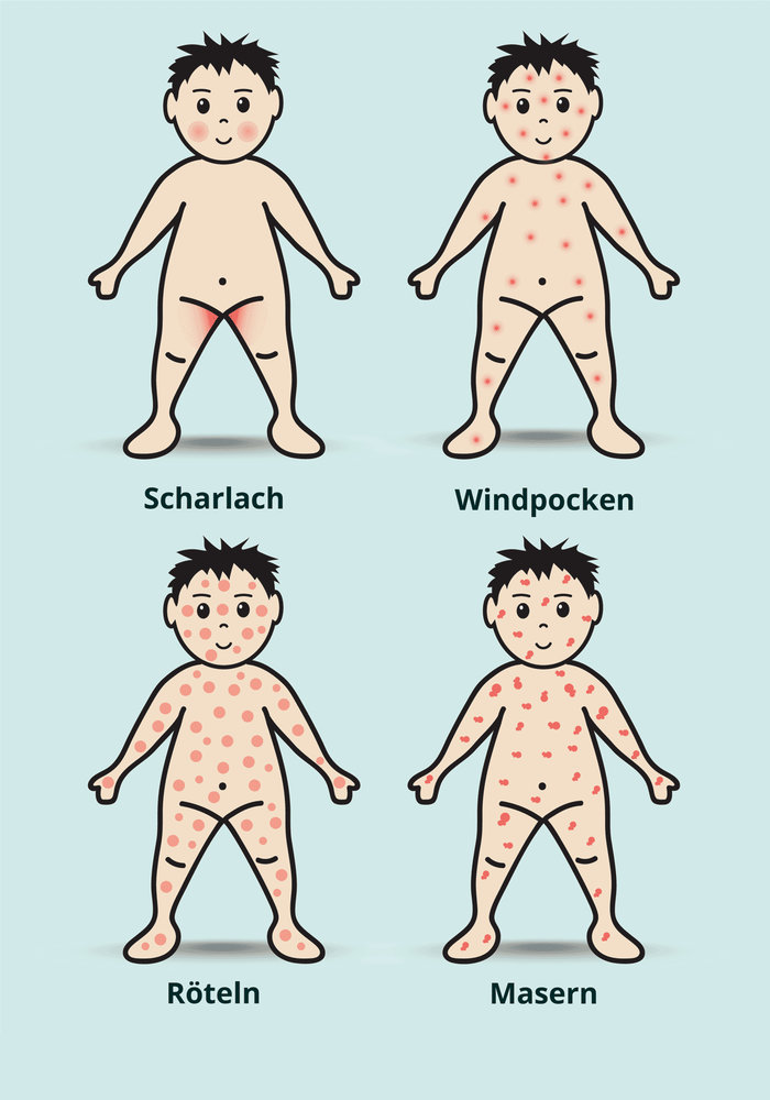 kinderkrankheiten-ausschlag.thumb.jpg.0171cf7bf6a251c2d65fd6c634c47359.jpg